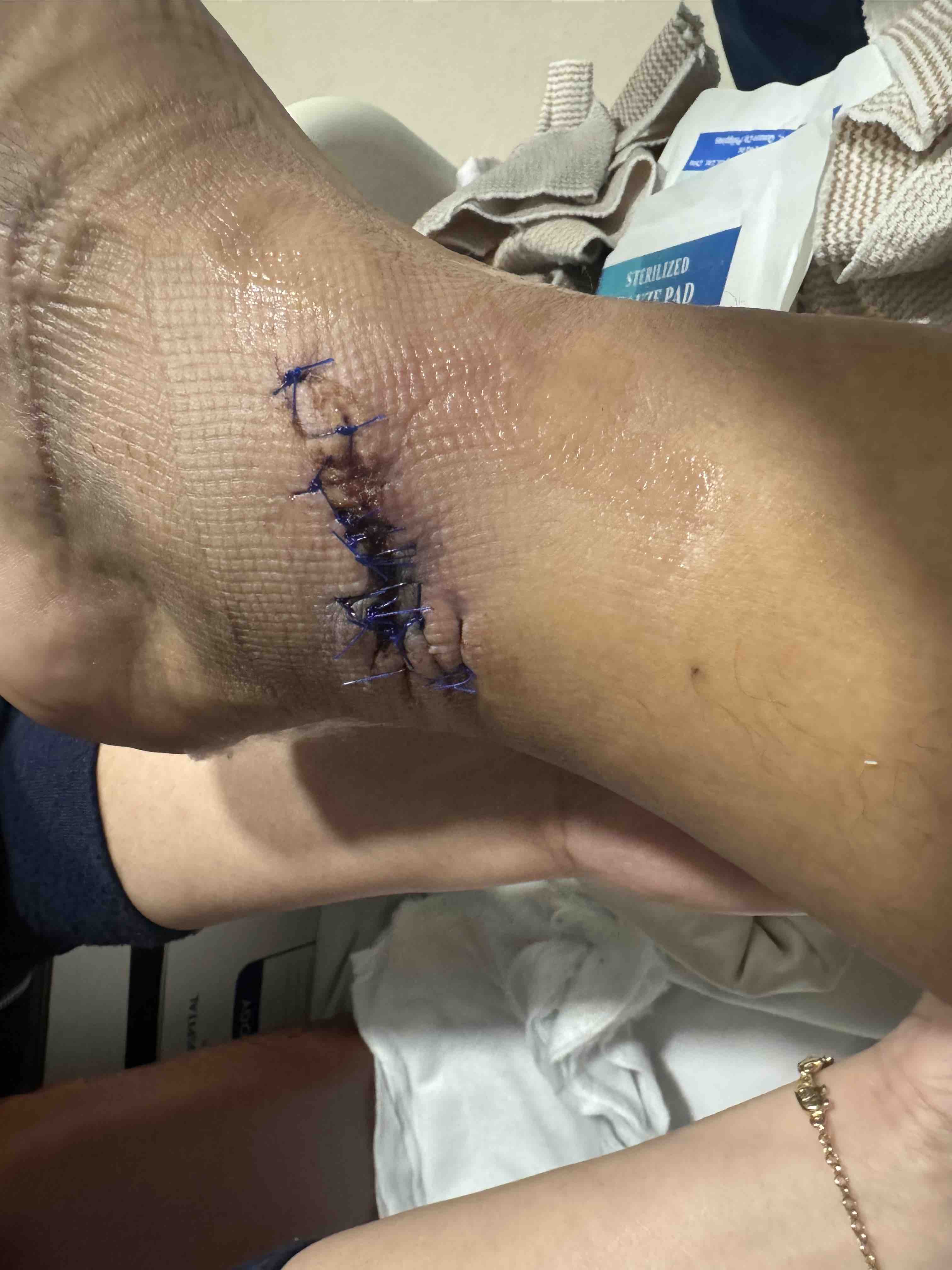 Advanced Wound Care Treatment 1 at Synergy Quezon City