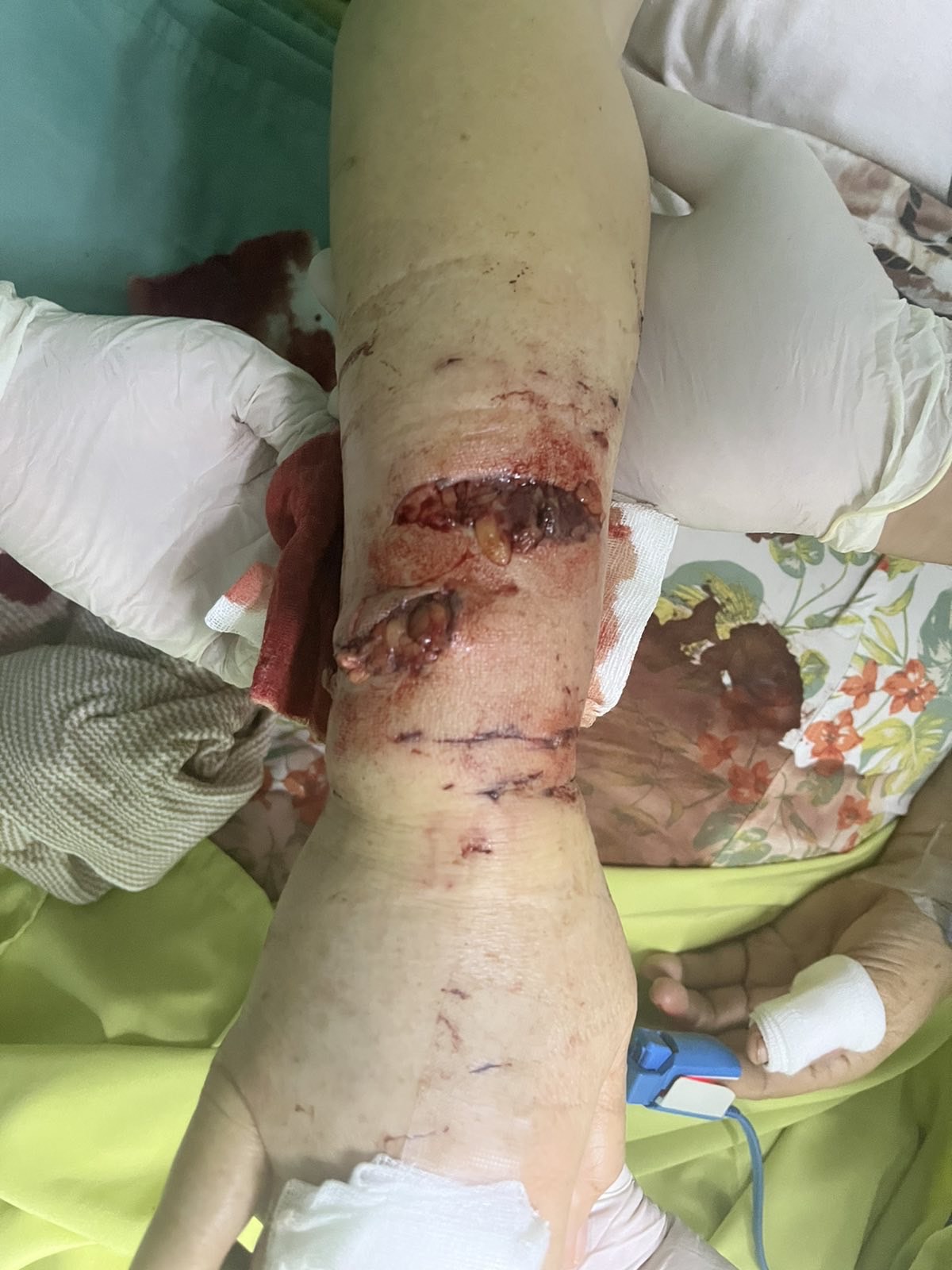 Advanced Wound Care Treatment 3 at Synergy Quezon City